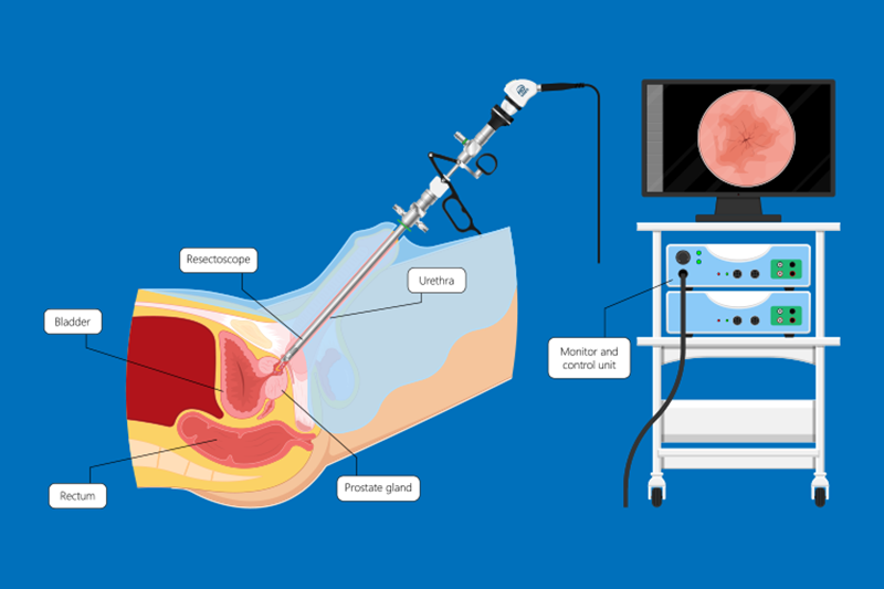 Bladder Irrigation Procedure: Path to Improved Health