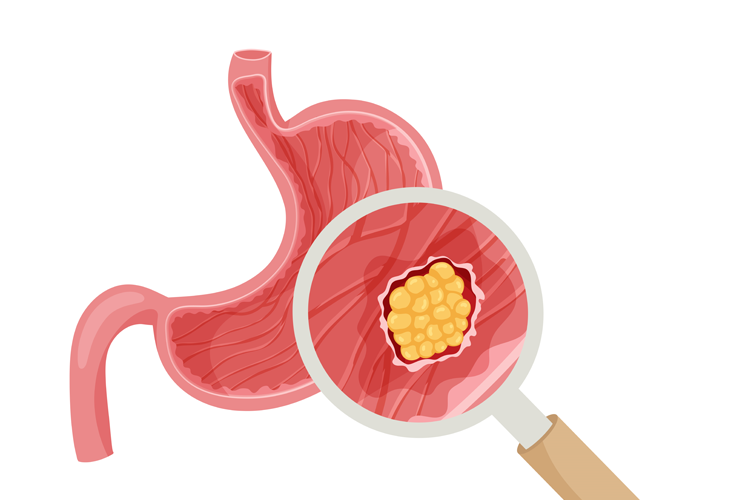 Stomach Cancer: Causes, Symptoms, and Treatment Options