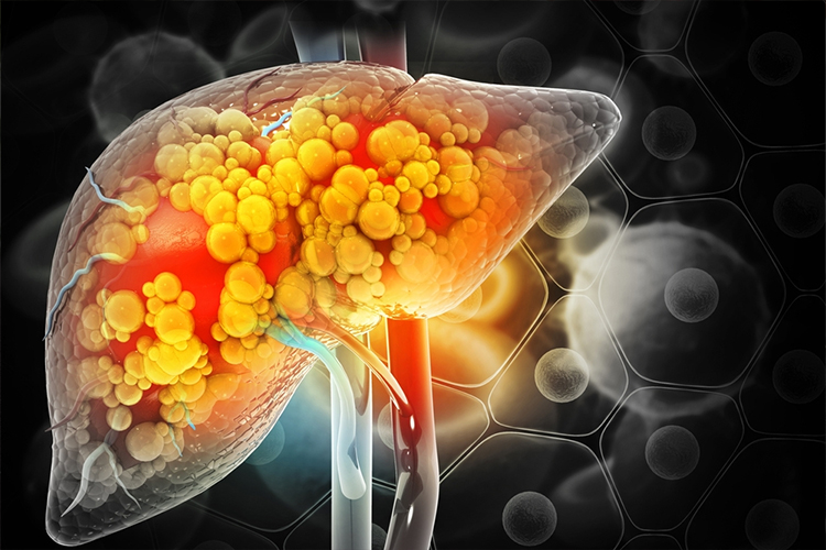 Fatty Liver -  Causes, Symptoms, Treatment, and Prevention