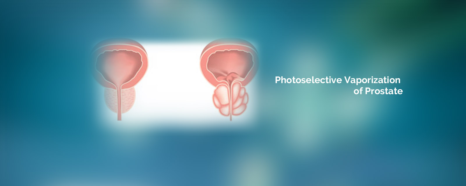 Pvp (Photoselective Vaporization Of Prostate)