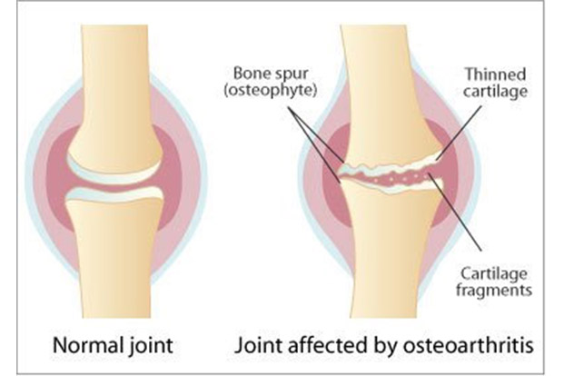 Osteoarthritis