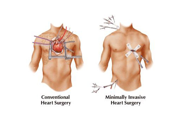 Type of Cardiac Surgery