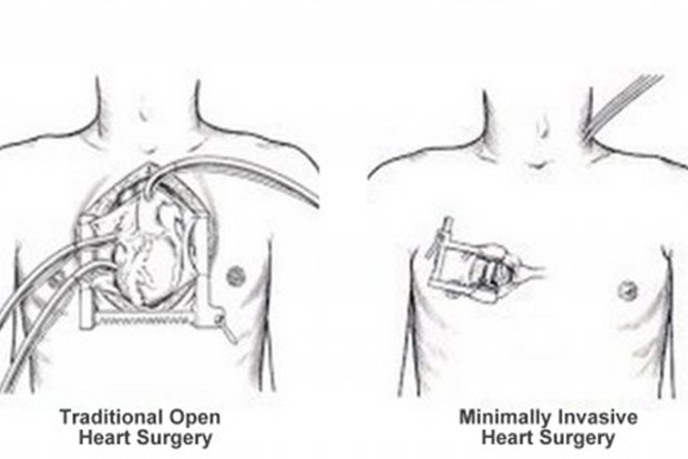 Now a No Scar Cardiac Surgery Possible!