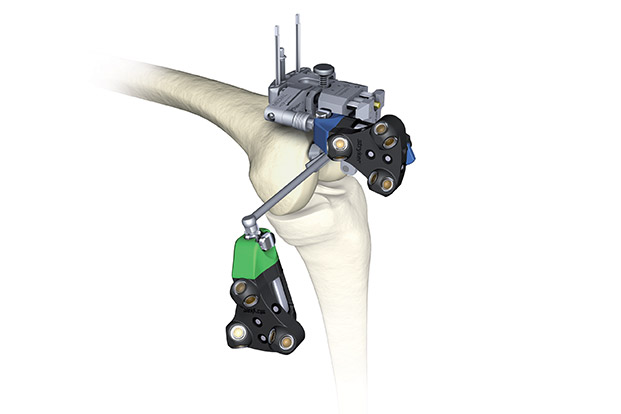 COMPUTER NAVIGATION IN TOTAL KNEE REPLACEMENT