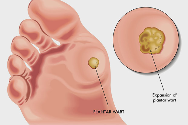 Corn or Wart , What do your feet have?