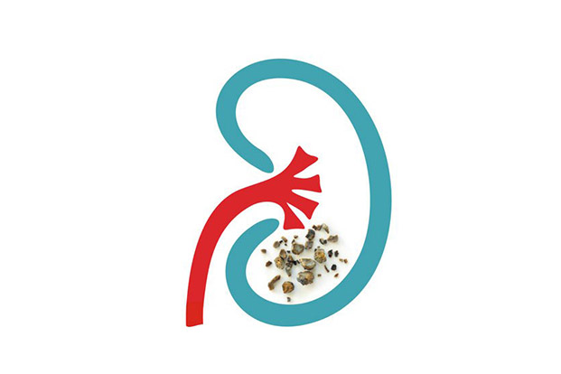 How are Kidney Stones treated?