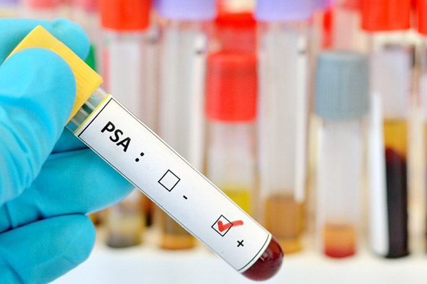 PSA Test – How it Works?