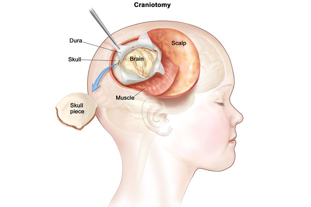 Craniotomy- Neuronavigation technique