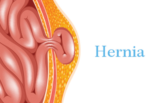 Hernia Surgery and Treatment