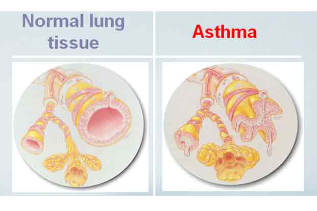 asthma affects on lungs