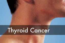 Thyroid Cancer- Signs, Symptoms & Management