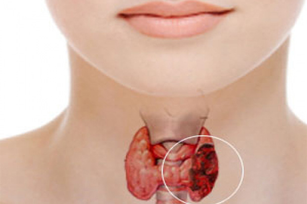 Thyroid Disease: Know the Facts