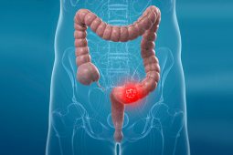 Colorectal Cancer: Risk Factors and Prevention