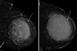 Metaplastic Carcinoma of Breast