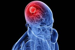 Dietry Therapy in Brain Tumor?