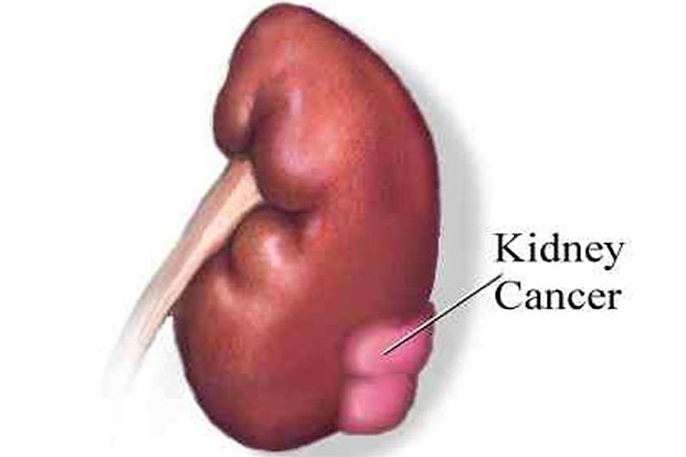 Causes and symptoms of kidney cancer