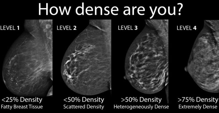 Symptoms of Stage 4 Breast cancer