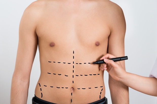 Liposuction may not help you lose weight completely
