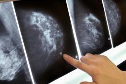 Role of Radiology  in Diagnosis of Breast Cancer 