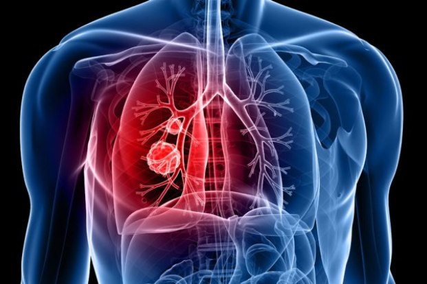 Pneumococcal Pneumonia: Causes, Symptoms, Transmissions, Diagnosis and Treatment