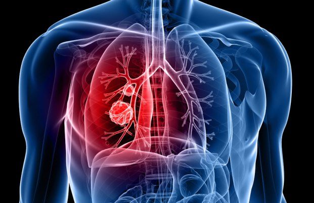 Causes & Symptoms of Pneumonia 