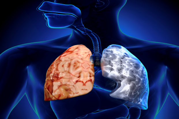 Several factors for COPD progression 