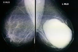 MAMMOGRAPHY IN BREAST CANCER