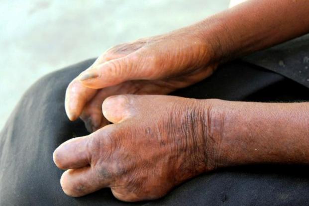 Signs and Symptoms of Leprosy