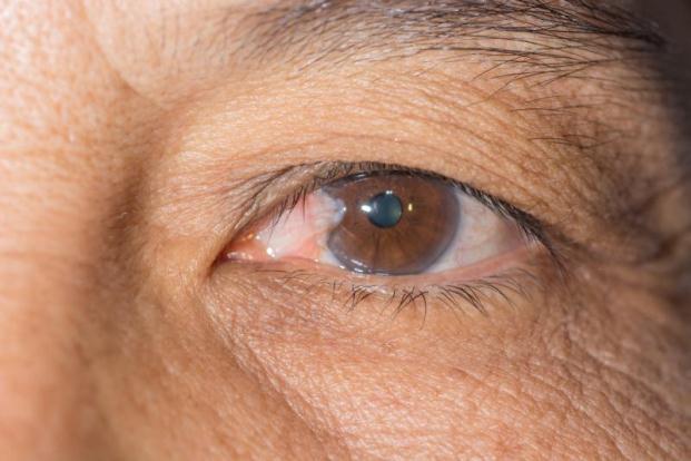 Glaucoma - High Internal Eye Pressure That Causes Vision Loss