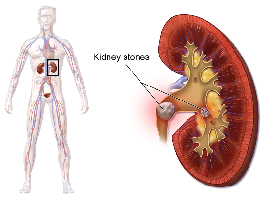 9 Ways to Prevent Kidney Stones