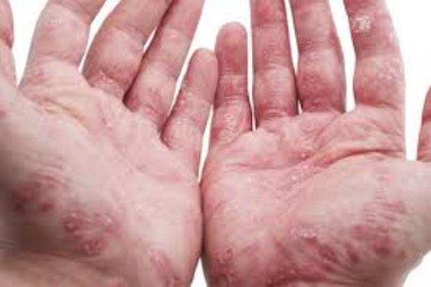 Psoriatic arthritis and its symptoms