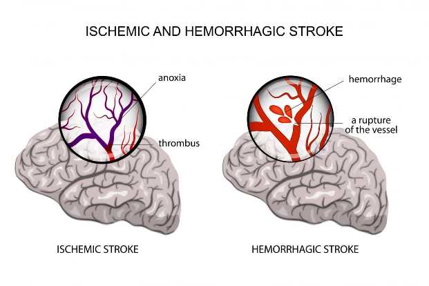 Different Types Of Strokes