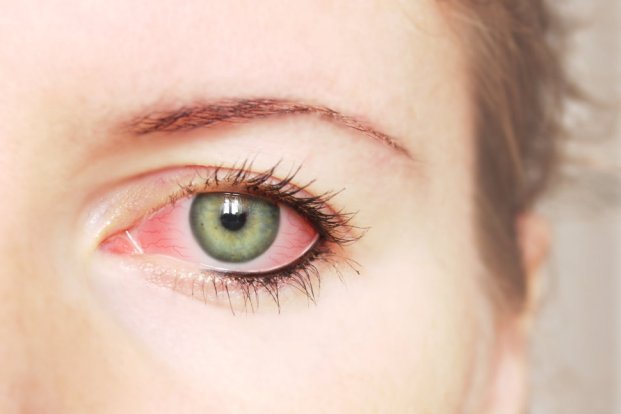 Best Pink Eye- Conjunctivitis Remedies