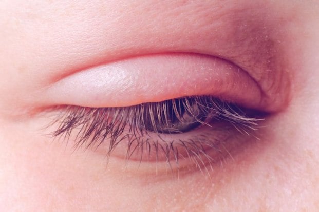 upper eyelid infection