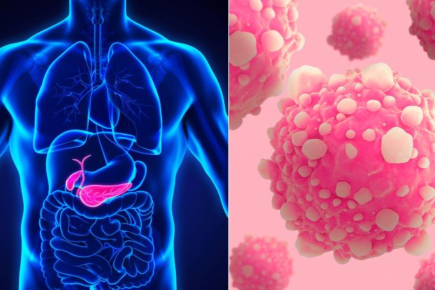 Types of inoperable pancreatic cancer