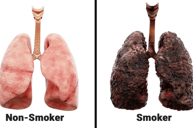 Effects of smoking on lungs