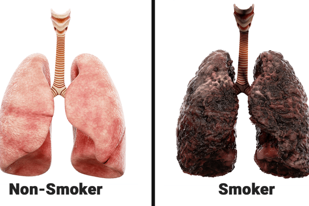 cigarette smoker lungs