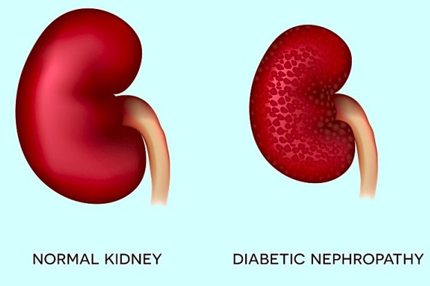 Diabetic kidney disease: Overview