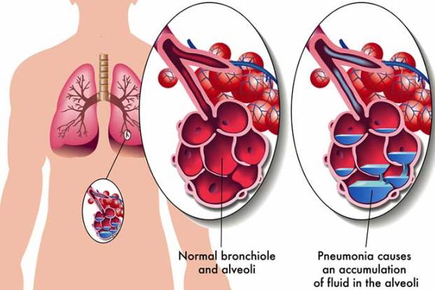 Pneumonia can be a life-threatening infection