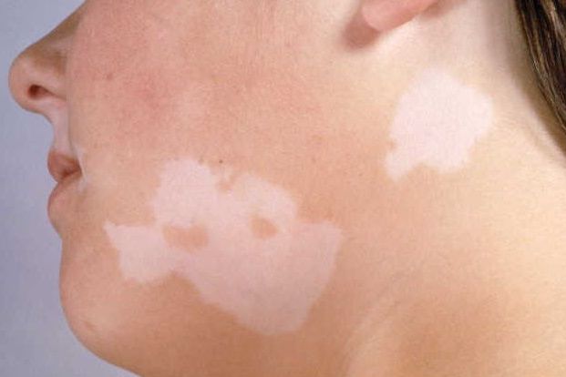 What causes white spots on the skin?