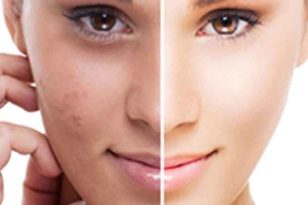 Benefits and Risks of Laser Resurfacing