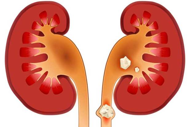 Risk factors & diagnosis of Kidney stones