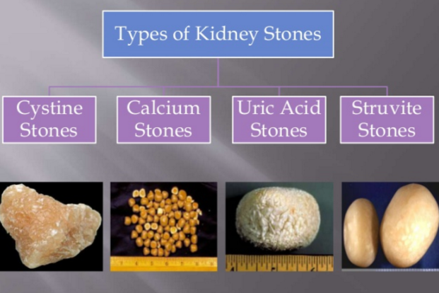 Causes and types of kidney stones