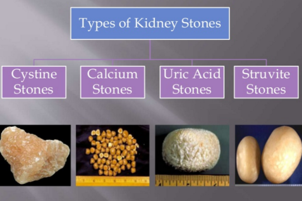 calcium phosphate stones