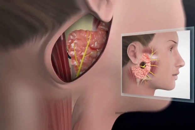 Parotid Tumours