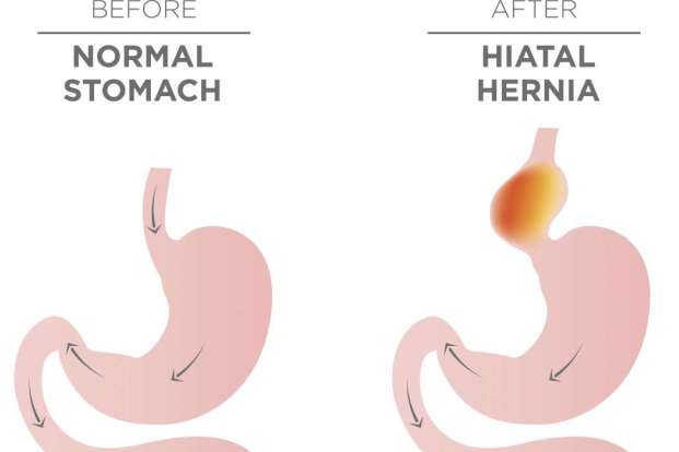 What Are Hernia Symptoms and Signs?