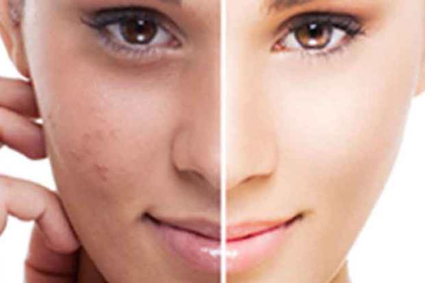 What is hyperpigmentation?