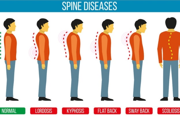 Types and causes of spine curvature disorders