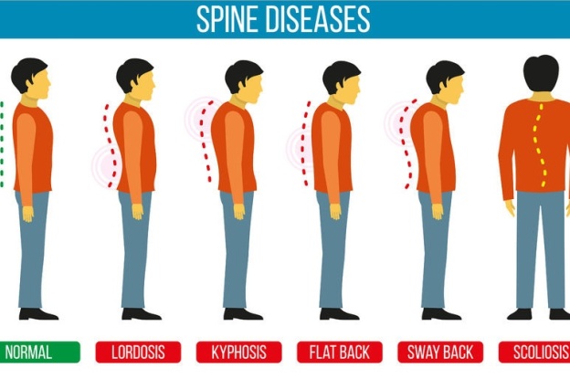 scoliosis types