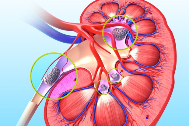 Surgical treatment of kidney stones